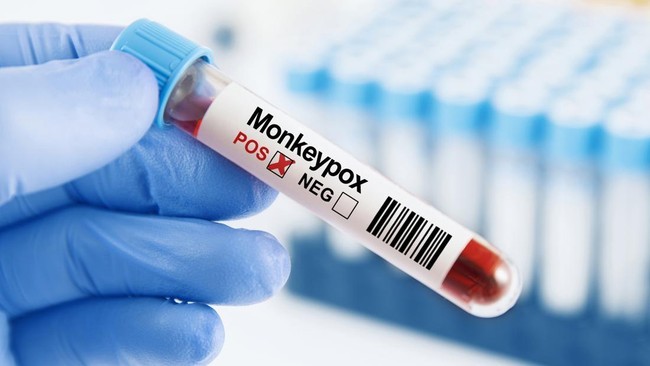 DINKES DKI Jakarta mengonfirmasi penambahan dua kasus cacar monyet atau monkeypox di Jakarta. Ilustrasi (iStockphoto/anilakkus)