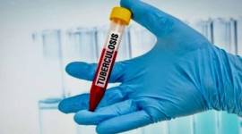 Foto Ilustrasi - Pemeriksaan Tuberkulosis (TBC). (ANTARA/HO-Shutterstock)