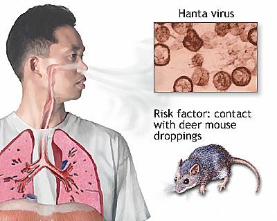 Foto Ilustrasi. (Foto: medlineplus.gov)
