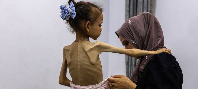 Seorang gadis yang menderita malnutrisi parah di Gaza. Tim bantuan telah berulang kali meminta Israel untuk mengizinkan lebih banyak bantuan masuk ke Gaza guna mencegah bencana kemanusiaan yang sedang berlangsung. (Foto: ©WHO) 