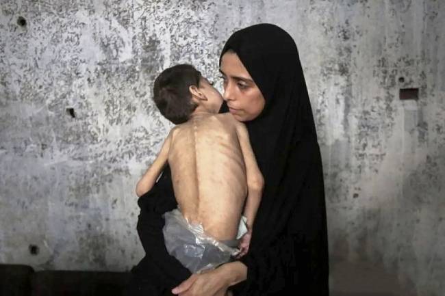 Seorang anak Palestina yang menderita kurang gizi dan cerebral palsy digendong ibunya di tempat pengungsian di Gaza, Palestina, 25 Juli 2025. (Dok ANTARA FOTO/Xinhua/Rizek Abdeljawad)