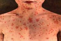 ilustrasi terkenacampak