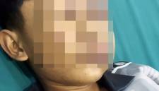 Irfan Zaki Azizi, seorang santri di Kubu Raya lebam pada wajah dan belum sadarkan diri. (Foto: Istimewa)